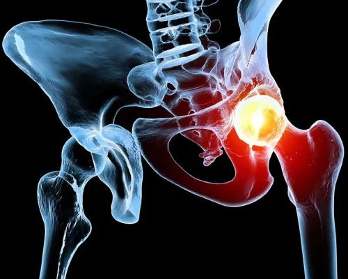Hip osteoarthritis family history