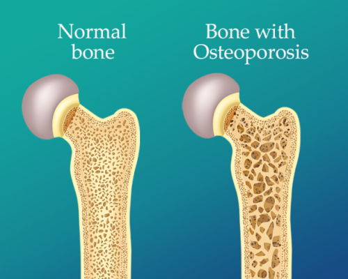 Osteoporosis prevention thumb detail